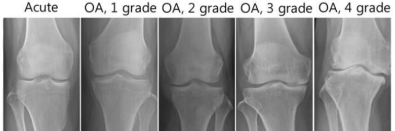 bol osteoartritisa koljena